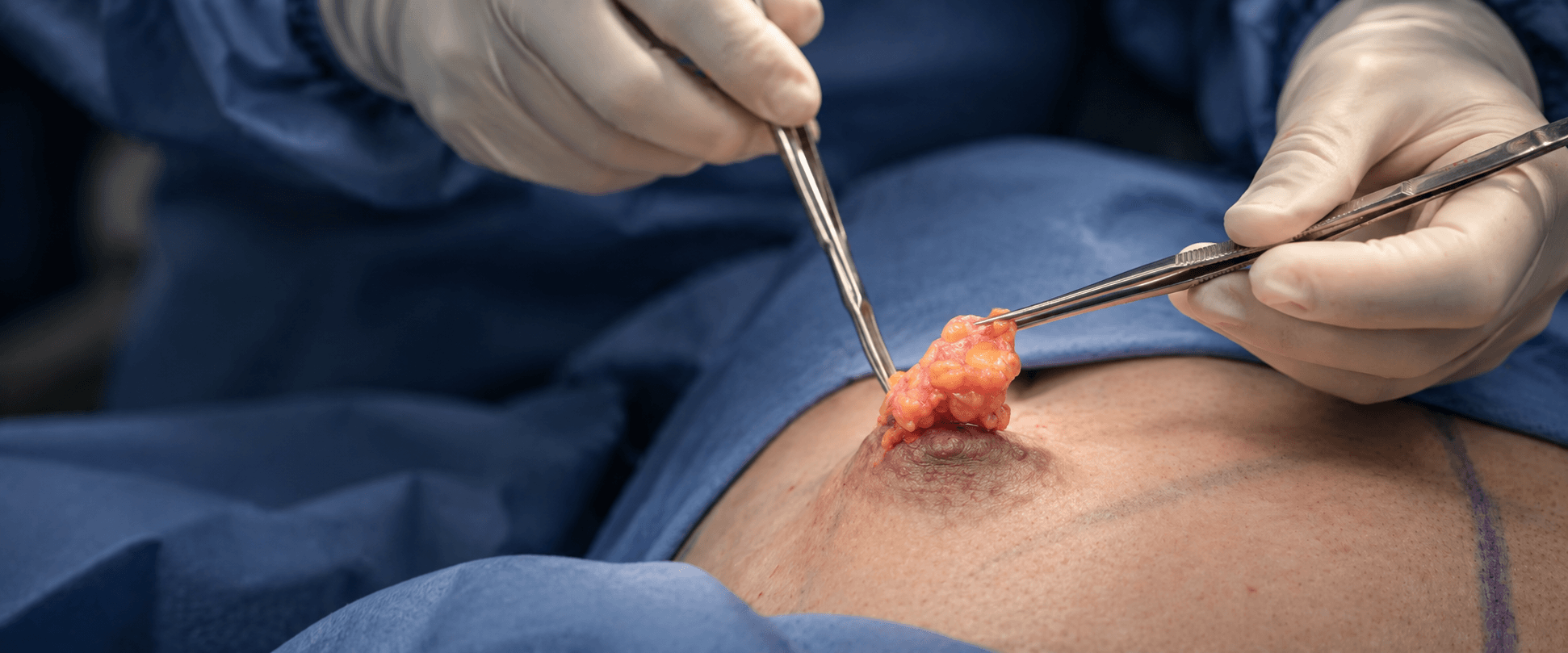 Gynecomastia Gland Removal
