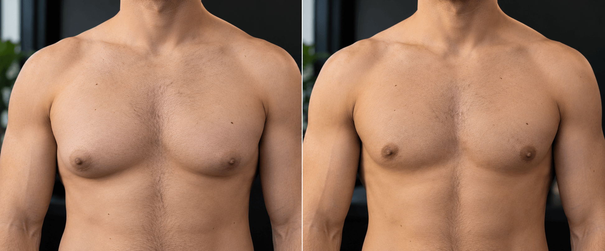 Pseudogynecomastia Surgery